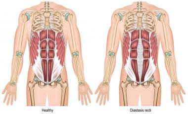 Beyaz arka plan üzerinde Diyastasis recti 3d tıbbi vektör illüstrasyon