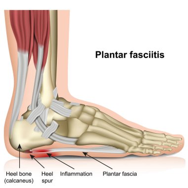 beyaz arka plan üzerinde plantar fasiit 3d tıbbi vektör illüstrasyon