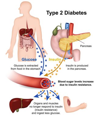 Type 2 diabetes medical vector illustration with english description