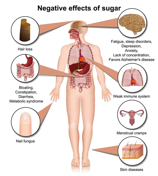 Efectos Secundarios Del Azúcar Cuerpo Humano Vector Médico Ilustración — Vector de stock