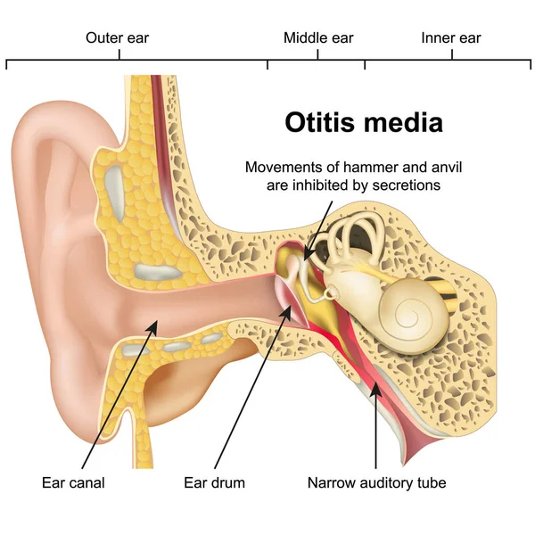 Otitis Media Enfermedad Del Oído Vector Médico Ilustración Sobre Fondo — Archivo Imágenes Vectoriales