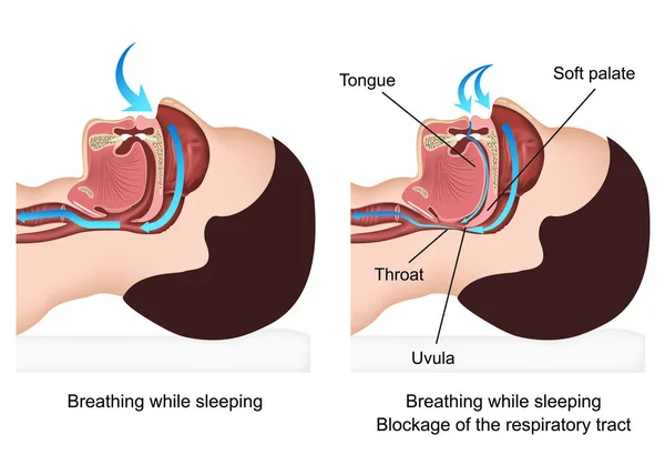 Ronquidos Ilustración Vector Médico Con Descripción Sobre Fondo Blanco — Archivo Imágenes Vectoriales