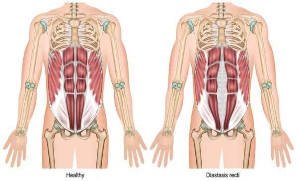 Diastasis Åtgärdats Medicinsk Vektor Illustration Vit Bakgrund — Stock vektor