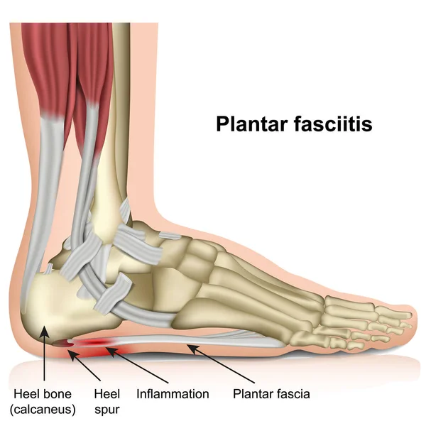 Fascitis Plantar Vector Médico Ilustración Sobre Fondo Blanco — Vector de stock