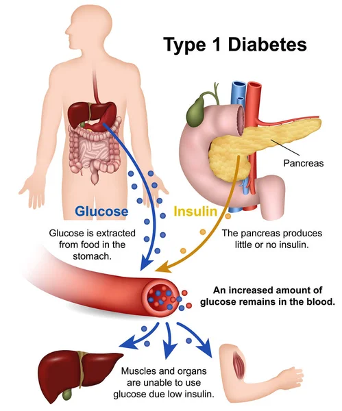 Tipo Diabetes Vector Médico Ilustración Con Descripción Inglés — Vector de stock