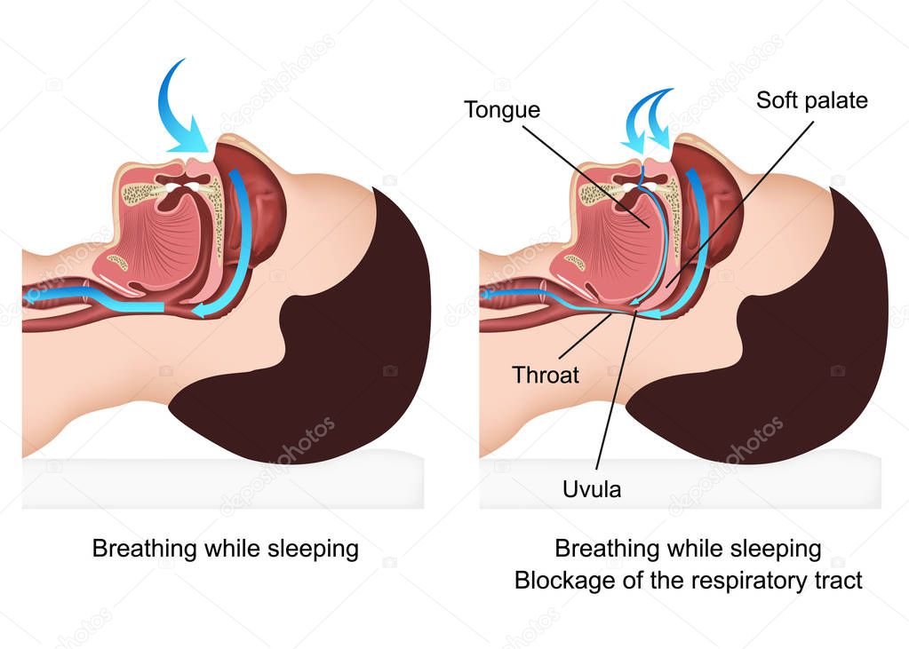 Snoring medical vector illustration with description on white background