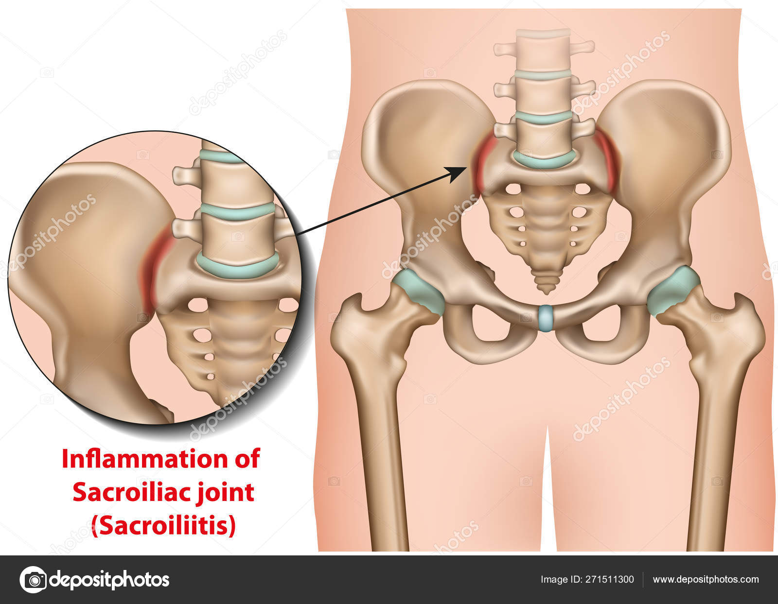 sacroiliacalis osteoarthritis