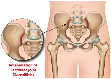 Sakroiliak eklem iltihabı 3d tıbbi vektör illüstrasyon sacroiliitis
