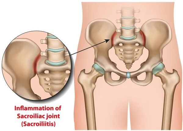 Sacroiliac Joint Inflammation Medical Vector Illustration Sacroiliitis — Stock Vector