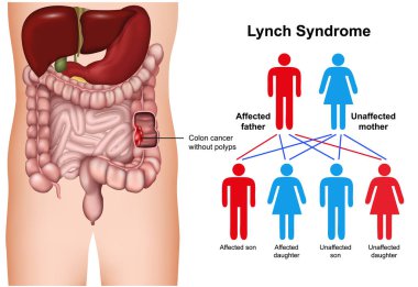 Lynch sendromu hastalığı. Beyaz arka planda 3 boyutlu tıbbi vektör çizimi.