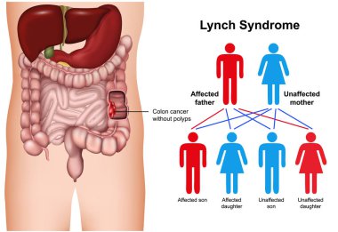 Lynch syndrome disease 3d medical vector illustration on white background clipart