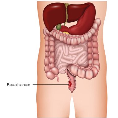 rectal cancer medical 3d vector illustration on white background, colorectal cancer clipart