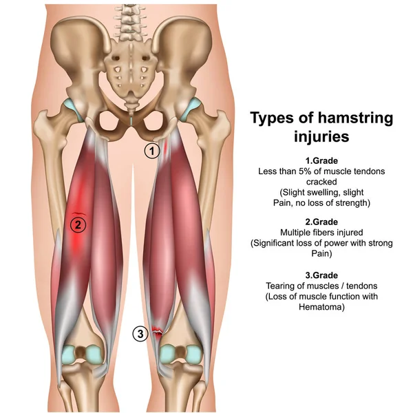 Beyaz arkaplanda üç boyutlu tıbbi vektör illüstrasyonunu yaralayan hamstring türleri