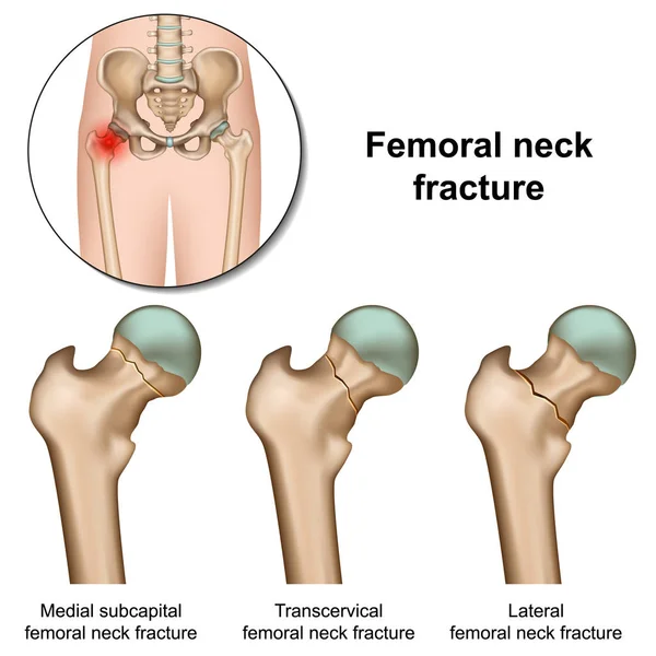 Fracturas Cuello Femoral Vector Médico Ilustración Sobre Fondo Blanco — Vector de stock