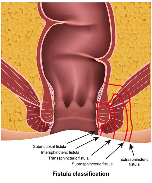 fistula classifications medical vector illustration on white background with description
