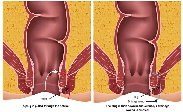 Fistula Plug Ilustração Vetorial Médica Fundo Branco Com Descrição — Vetor de Stock