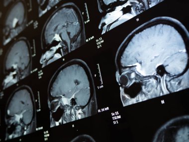 Film x Ray beyin tümörü annem Bangkok Tayland