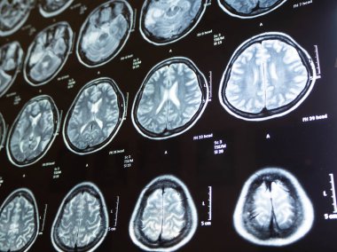 Film x Ray beyin tümörü annem Bangkok Tayland