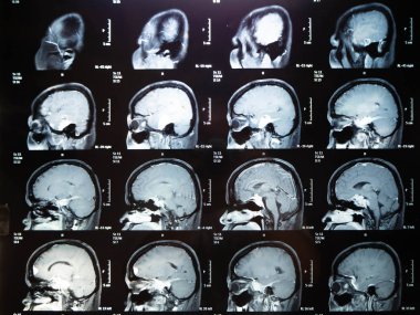 Film x Ray beyin tümörü annem Bangkok Tayland
