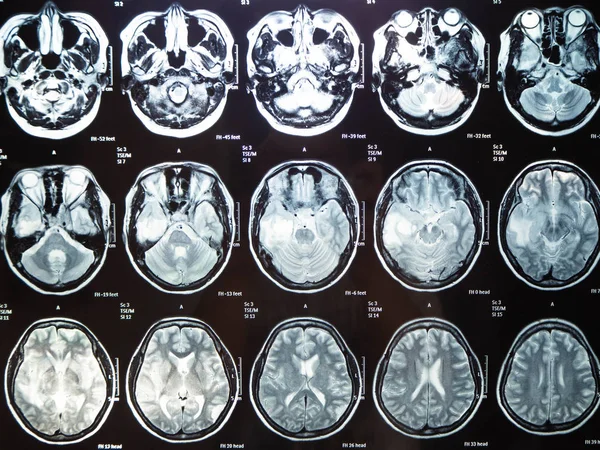 Film x ray brain tumor my mother Bangkok Thailand