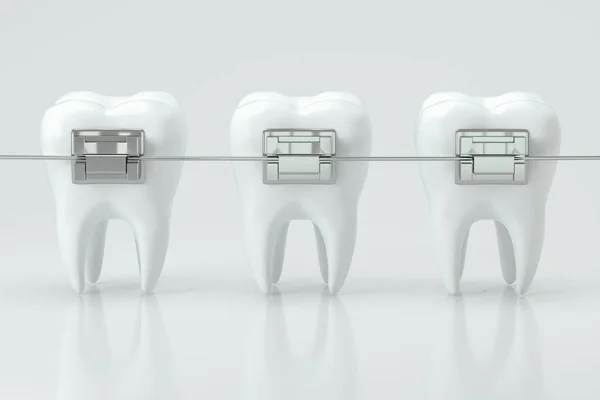 Apparecchi Dentali Denti Rendering Disegno Digitale Del Computer — Foto Stock