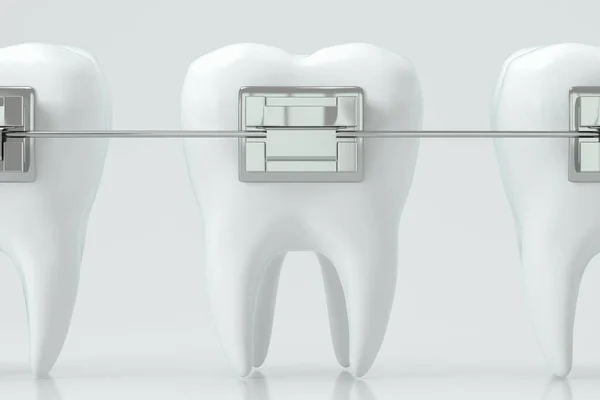 Aparelhos Dentários Dentes Renderização Desenho Digital Computador — Fotografia de Stock