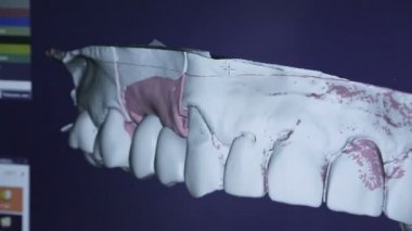 Diş teknisyeni implant çene içinde 3d model görür