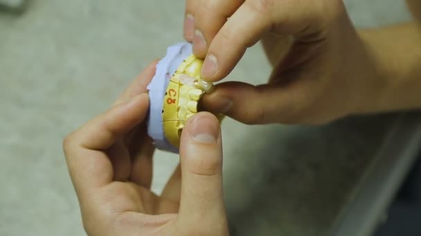 Зубной техник удаляет и кладет корону на макет зуба — стоковое видео