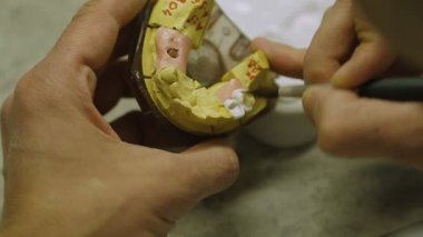 Bir diş taç diş teknisyeni yapar