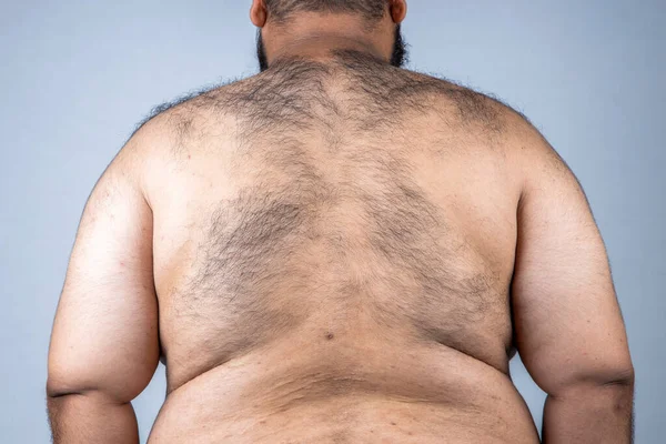 A fat man with a shaggy beard. Obese people. The Dangers of Belly Fat. Fat man with a big belly , Men at risk for diabetes. Obese people with diabetes.