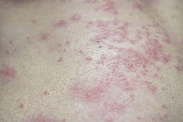 Itchy Rash Skin Rash On Body Itchy Red Rash On The Abdomen Of Women Stock Images Page Everypixel