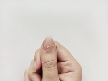 White Spots on Nail isolated on white background. Disease leuconychia clipart