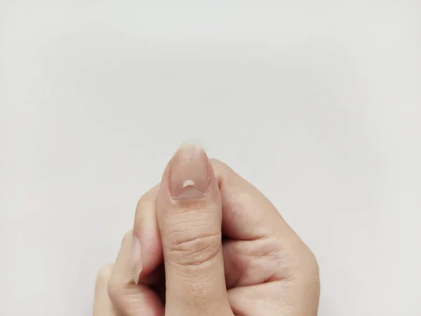 Taches blanches sur ongle isolé sur fond blanc. Leuconychie Photo De Stock