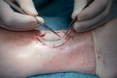 bir doktor bir cerrahi işlem yapar