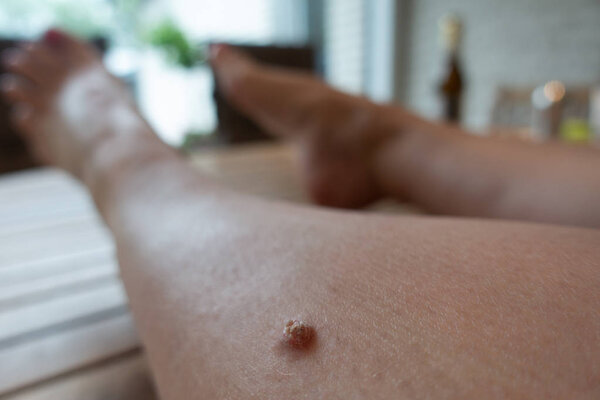 an unattractive wart has formed on the shinbone