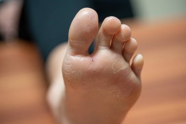 bir ayak üzerinde cilt egzama nedeniyle ayırır