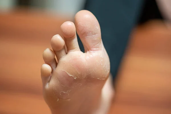 on one foot the skin detaches due to eczema