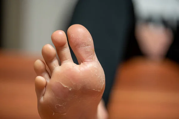 Sur un pied la peau se détache en raison de l'eczéma — Photo