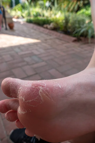 La piel se desprende de un pie debido a una enfermedad — Foto de Stock