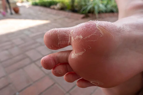 La piel se desprende de un pie debido a una enfermedad — Foto de Stock