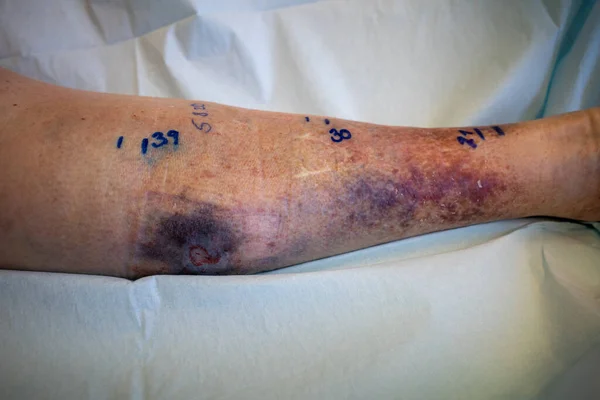 Büyük bir hematom alt bacakta bulunur, yayılımı bir kalemle işaretlenir.