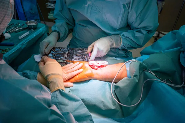 Dwóch Lekarzy Operuje Złamanie Nadgarstka Sali Operacyjnej — Zdjęcie stockowe
