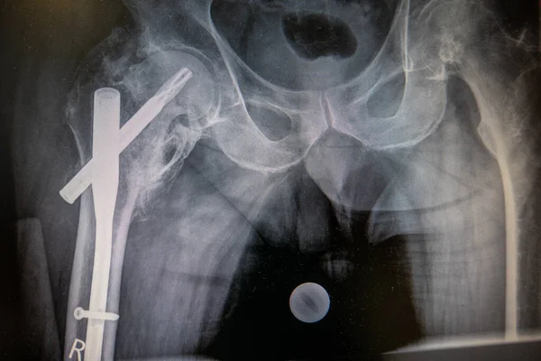 An X-ray of a hip with an implanted femoral nail — Stock Image Ray Hip Implanted Femoral Nail Stock Picture