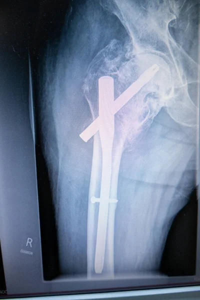 An X-ray of a hip with an implanted femoral nail — Stock Image Ray Hip Implanted Femoral Nail Royalty Free Stock Images