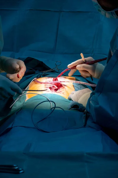 Bir Ameliyathanede Karın Ameliyatı Yapılır — Stok fotoğraf