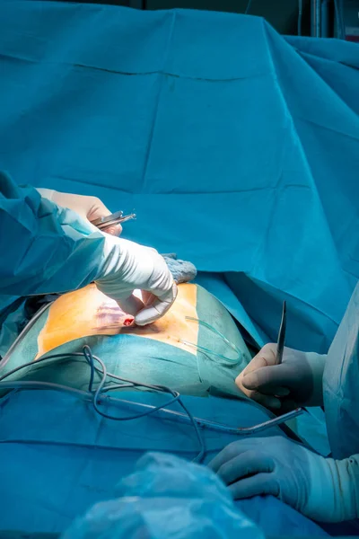 Bir Ameliyathanede Karın Ameliyatı Yapılır — Stok fotoğraf