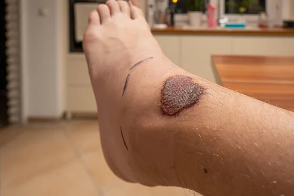 on one ankle is a large abrasion in the shape of a heart