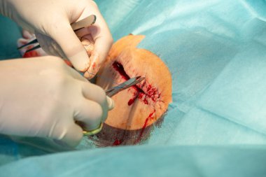Bir doktor iğne tutacağı ve cımbızla uzun bir ameliyat yarasına dikiş atar.
