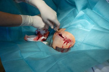 Bir doktor şırınganın içindeki lokal anestezi ile cerrahi bir yaranın içine sızar.