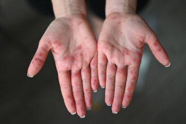 Kırmızı isilik ve deri tahrişi olan insan avuçlarına yakın çekim, olası alerji veya enfeksiyon belirtileri. 